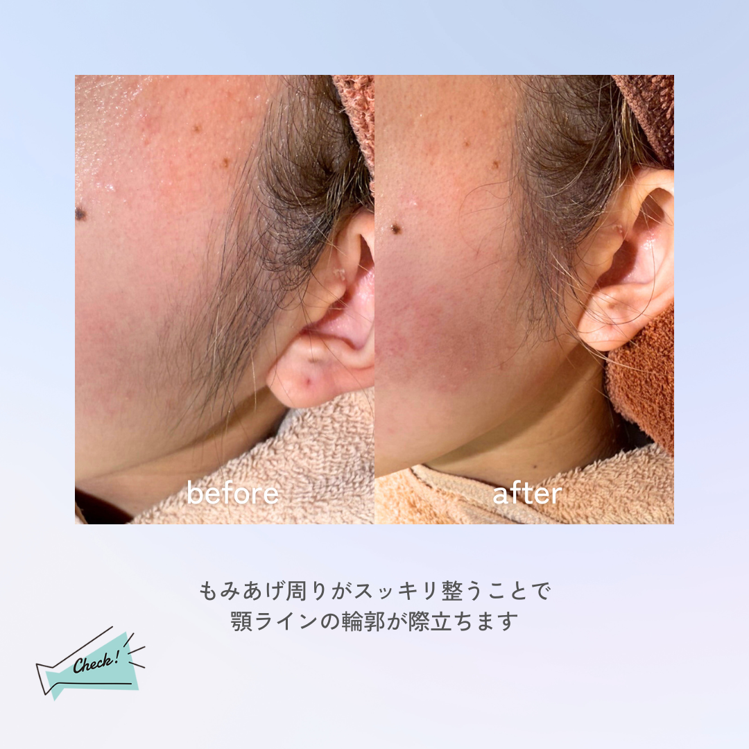 もみあげビフォアフ